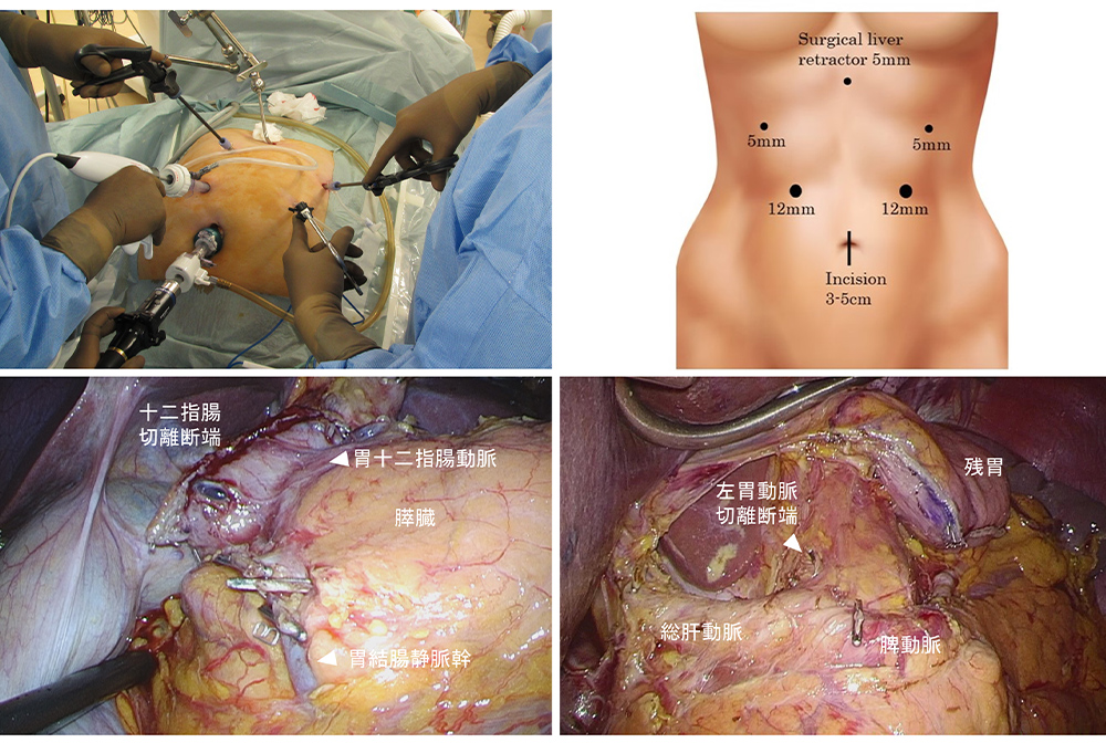 腹腔鏡下幽門側胃切除術