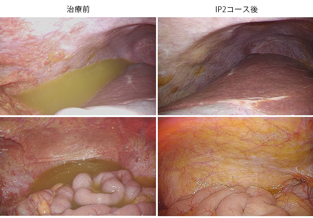 腹腔内化学療法（IP療法）